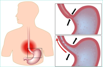 Hogyan kezeljük reflux oesophagitis, gastritis