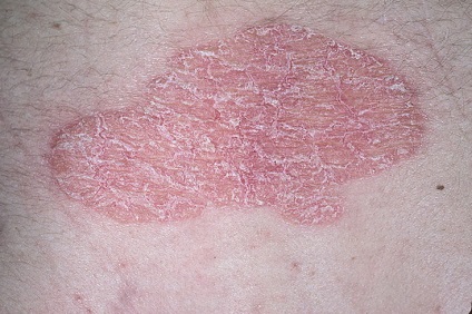 Megkülönböztetve psoriasis allergia (allergia) Hogyan lehet megkülönböztetni az allergia psoriasis