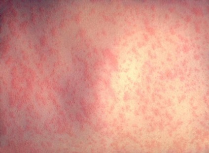 Megkülönböztetve psoriasis allergia (pikkelysömör) Hogyan lehet megkülönböztetni az allergia psoriasis