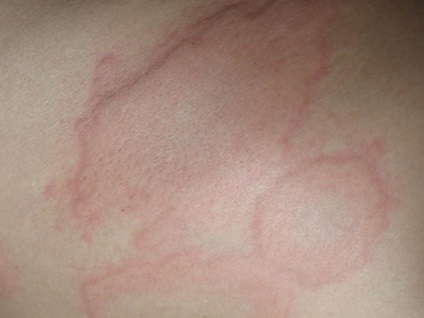 Megkülönböztetve psoriasis allergia (allergia) Hogyan lehet megkülönböztetni az allergia psoriasis