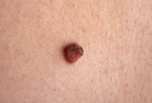 Hogyan lehet megkülönböztetni a melanoma egy anyajegy - fotók, jellemzők, funkciók, megjelenés
