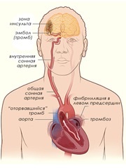 kardioembóliás stroke