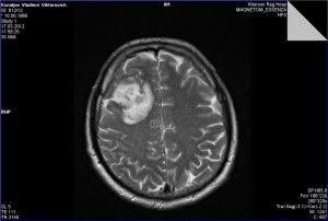 agyi ciszta kezelés népi jogorvoslati Pathology