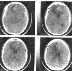 A klinikai kép a stroke (szélütés) A klinikai kép a stroke