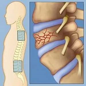 Kompressziós törés az ágyéki gerinc