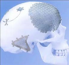 Cranioplasty - idegsebészet Kiev