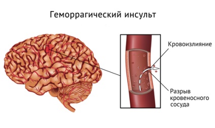 Vérzés az agyban hatások okoz, kezelés (videó)
