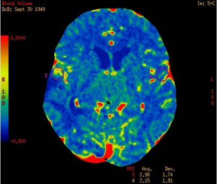agyi CT perfúziós képalkotás