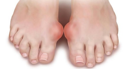 Kezelése osteoarthritis lábközép