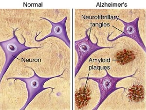 A kezelés az Alzheimer-kór és a profilaxis fitoterápia