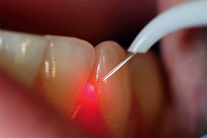 Gum lézeres kezelés - egy innovatív módszer és ellenjavallatok