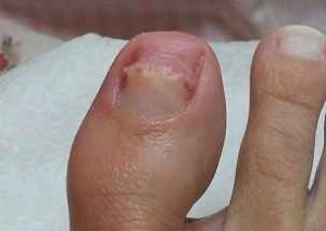 gomba foot nail foot tünetei)