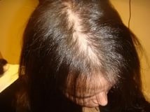 Alopecia kezelésére benzil-benzoát - projektek - okoz kopaszság nők Stage 2