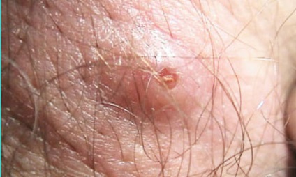 Légy lárvája az emberi bőr alá - myiasis betegség fotó, videó