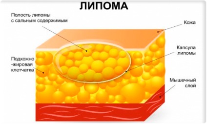 Lipoma (wen) tünetei gyermekekben, fotó és kezelési módszerek (lipoma) Lipoma (wen) tünetek gyermekeknél és fotó kezelések