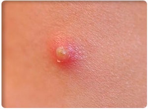 Lipoma (wen) tünetei gyermekekben, fotó és kezelési módszerek (lipoma) Lipoma (wen) tünetek gyermekeknél és fotó kezelések