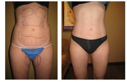 Zsírleszívás a has előtt és után, mivel az eljárás történik, ha az alkalmas a férfiak, video vélemény