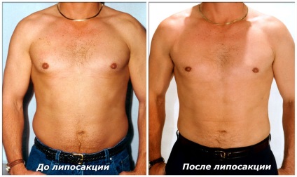 Zsírleszívás a has előtt és után, mivel az eljárás történik, ha az alkalmas a férfiak, video vélemény