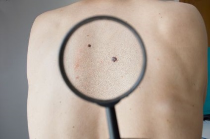 Melanoma mol vagy jelek és tünetek, típusok és a kockázati tényezők, a megelőzés