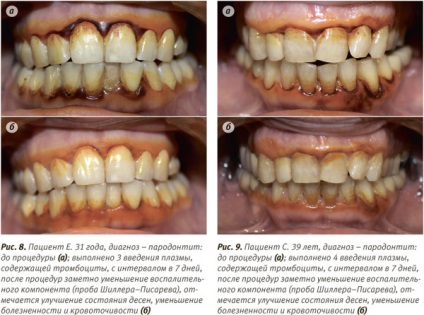 A technika, a szükséges feltételek és ellenjavallatok fogászati ​​Plazmolifting vélemények