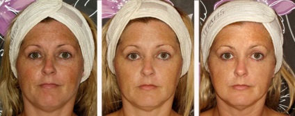 Mezoterápia arc - Hogyan szépség koktélok