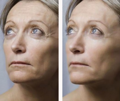 Mezoterápia arc - Hogyan szépség koktélok