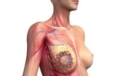 Breast miómák mi ez, az a betegség tünetei, tünetek, kezelés