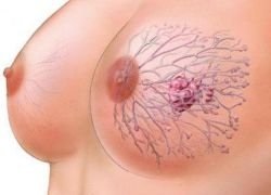 Breast miómák mi ez, az a betegség tünetei, tünetek, kezelés