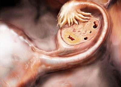 Lehet, hogy terhes, miután a méhen kívüli terhesség, hány lehetőség van eltávolítása után a csöveket