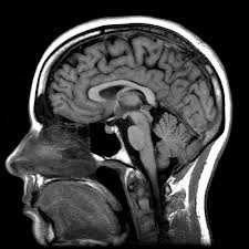 MRI az agy, a vérerek