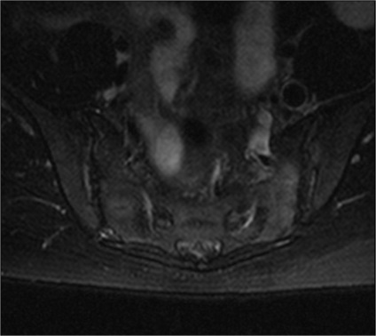 MRI a sacroiliacális közös, Dikulja Központ