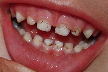 A fogakon képződő bevonatot Black - ok kialakulását, kezelése és megelőzése