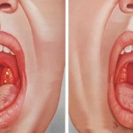 Народні засоби для лікування гострого тонзиліту що і як застосовувати, болить горло