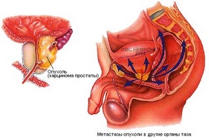 prosztata reproduktív funkció a prosztata gyulladása ellen