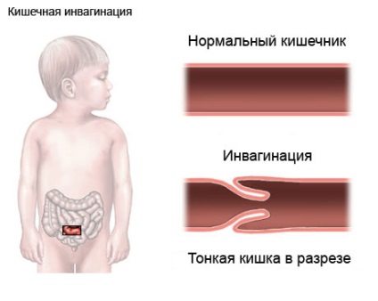 bélelzáródás csecsemők tünetek, mit kell tenni