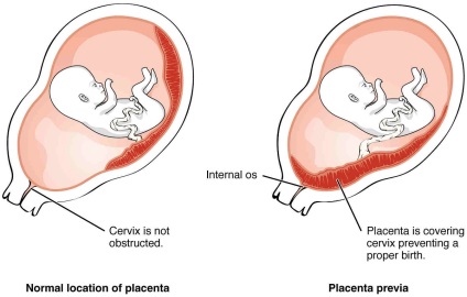 Alacsony placentatio terhesség 20. hete, a hely és bemutatása, mint az alacsonyabb arcok