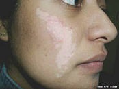 A legújabb kezelési módszer a vitiligo hatóanyag sanum cutis