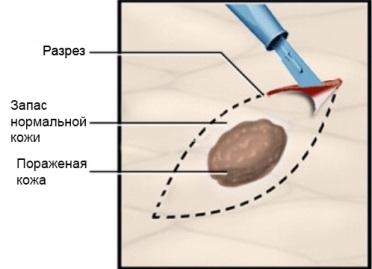 Összesen excisional biopszia