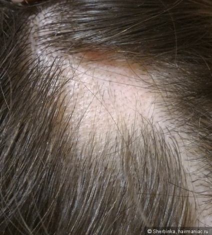 Alopecia areata - szörnyű dolog egy lány! Tudtam, hogy megoldja ezt a problémát az ő részét (alopecia) Alopecia areata - szörnyű dolog egy lány! Tudtam, hogy megoldja ezt a problémát az ő részét