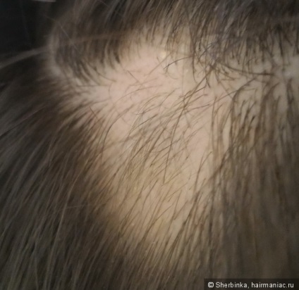 Alopecia areata - szörnyű dolog egy lány! Tudtam, hogy legyőzze ezt a problémát megosztják (nők) Alopecia areata - szörnyű dolog egy lány! Tudtam, hogy megoldja ezt a problémát az ő részét