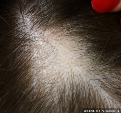 Alopecia areata - szörnyű dolog egy lány! Tudtam, hogy legyőzze ezt a problémát fogom megosztani a (sikertelen) Alopecia areata - szörnyű dolog egy lány! Tudtam, hogy megoldja ezt a problémát az ő részét