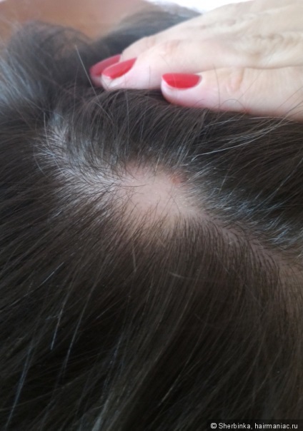 Alopecia areata - szörnyű dolog egy lány! Tudtam, hogy megoldja ezt a problémát az ő részét