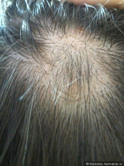 Alopecia areata - szörnyű dolog egy lány! Tudtam, hogy megoldja ezt a problémát az ő részét (kérdés) Alopecia areata - szörnyű dolog egy lány! Tudtam, hogy megoldja ezt a problémát az ő részét