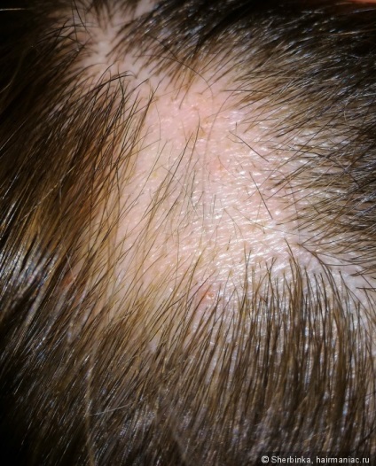 Alopecia areata - szörnyű dolog egy lány! Tudtam, hogy megoldja ezt a problémát az ő részét (alopecia) Alopecia areata - szörnyű dolog egy lány! Tudtam, hogy megoldja ezt a problémát az ő részét