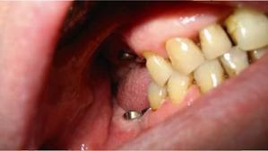 Egyfokozatú fogászati ​​implantátumok - mi ez, árak összehasonlítása előtti és utáni képek, és ellenjavallatok