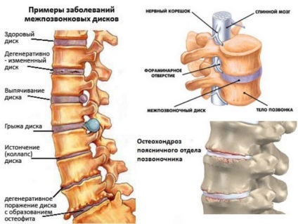 Osteochondrosis az ágyéki gerinc tünetek és kezelés okoz, a diagnózis