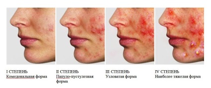 Tűnő pattanás (acne) az arcon