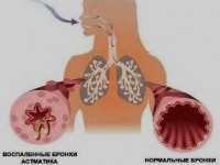 Duzzadása hörgők tünetei és kezelési módszerek - asztma - bronchitis - Pulmonológia és tuberkulózis