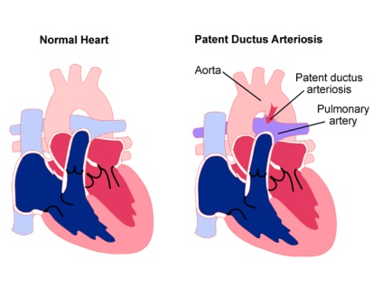 Nyitott ductus arteriosus gyermekek és felnőttek kezelésére, műtét, diagnosztika