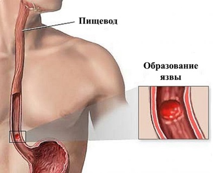 Burn oesophagealis tünetek, a kezelés (a tünetek) Burn nyelőcső tünetek, kezelés